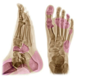 foot and ankle x-ray with pain points identified